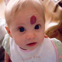 تعرف على الوحمة الدموية عند الرضع وأسبابها