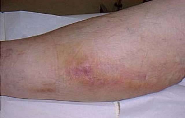أعراض جلطة الساق وطرق العلاج المرأة والصحة الصباح العربي