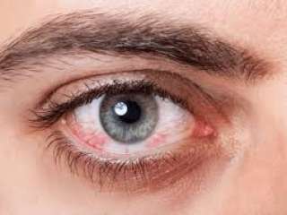 طرق علاج احمرار العيون بالاعشاب