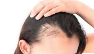 وصفات لعلاج الصلع وتساقط الشعر