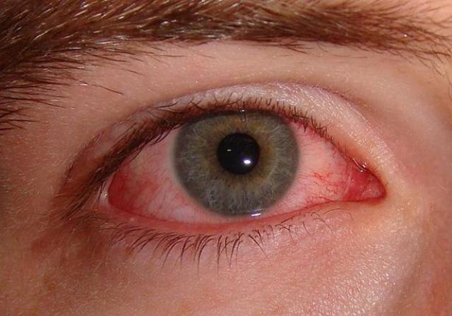 تعرف على اسباب جفاف العين عند الاستيقاظ | المرأة والصحة | الصباح العربي