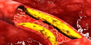 طريقة علاج الكوليسترول و ضغط الدم بالاعشاب