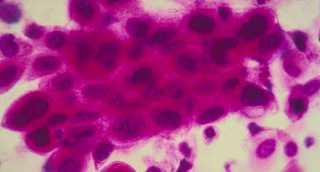 دراسة.. العلماء يكتشفون الخديعة الكبرى للخلايا السرطانية