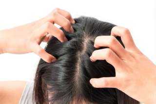 وصفات مجربة لعلاج قشرة الشعر