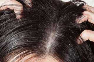 وصفات مجربة لعلاج قشرة الشعر