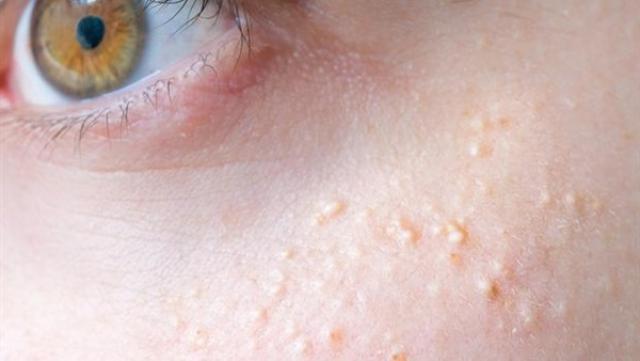 علاج مشكلة حبوب بيضاء في الوجه تحت الجلد المرأة والصحة الصباح العربي
