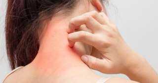 طرق منزلية فعالة لعلاج أعراض الصدفية على الجلد