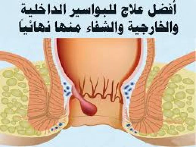 5 طرق منزلية فعالة لعلاج البواسير المرأة والصحة الصباح العربي