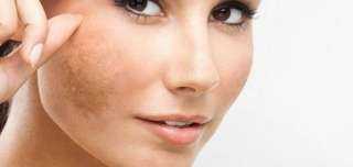 3 وصفات فعالة لعلاج البقع الداكنة في الوجه