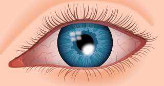 انواع التهاب قرنية العين ومشاكلها