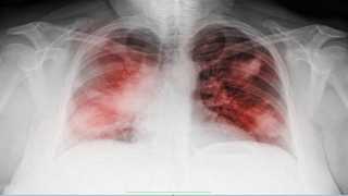 دراسة جديدة تفسر سبب انخفاض مستويات الأكسجين لدى مرضى ”كوفيد-19”