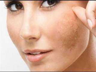 علاج البقع السوداء في الوجه طبيعياً