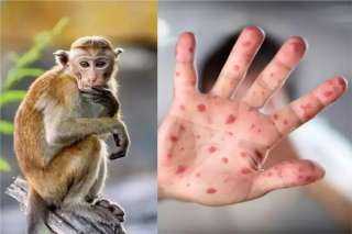 منظمة الصحة العالمية:  إصابة 131 بجدرى القرود و106حالات اشتباه فى 19 دولة