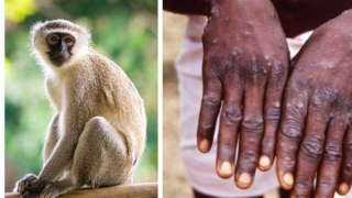 هاني الناظر: 90% من مصابي جدري القرود يتماثلون للشفاء دون دواء