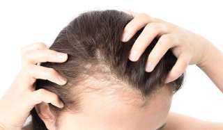 علاج انسداد بصيلات الشعر.. طرق طبية ومنزلية