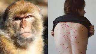 الصحة العالمية تحذر من تفشي ”جدري القرود”
