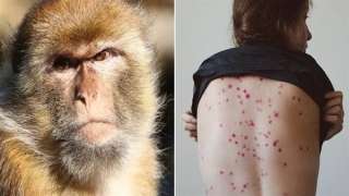 أمريكا تبدأ تطعيم الأشخاص «الأكثر عرضة للخطر» ضد جدري القرود