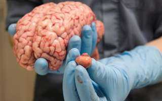 دراسة تتوصل لنتائج مذهلة حول قدرات أشخاص بنصف دماغ