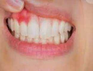 الفرق بين خراج اللثة وخراج الأسنان