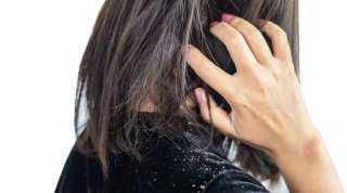 6 حلول فعالة لعلاج قشرة الشعر الموسمية
