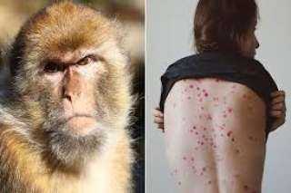 إيطاليا تسجل أول حالة مصابة بكورونا والإيدز وجدري القرود معا