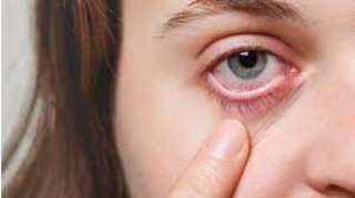اعراض حساسية العين وعلاجها