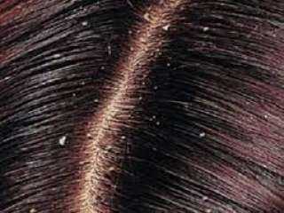 4 طرق سهلة للتخلص من قشرة الشعر