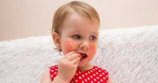 أطعمة تسبب الحساسية للأطفال
