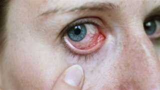 علامات السكري في العين.. أعراض يسببها المرض المزمن