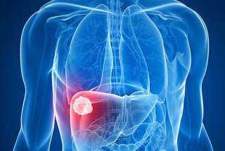 طبيبة توضح العلاقة بين تليف الكبد وسرطان الكبد