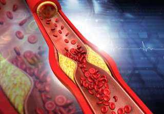 كيف تعرف بأنك تعاني من ارتفاع الكولسترول في الدم؟