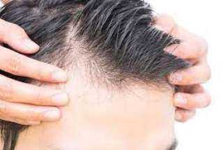 علاج تساقط الشعر من الأمام