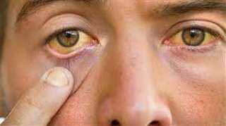 أعراض الفشل الكلوي على العين