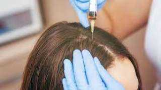 هل علاج الشعر بالخلايا الجذعية إجراء آمن؟