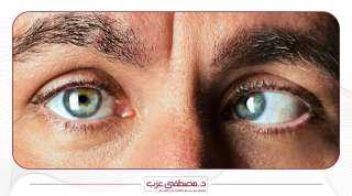 حول العين| أسبابه و4 طرق للعلاج