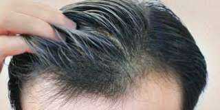 ما هي شروط زراعة الشعر؟